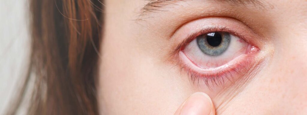 Clearing the Fog: Understanding and Managing Eye Infections